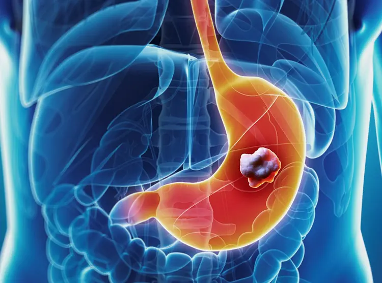 ไปตรวจอาการเจ็บคอ กลับพบว่าเป็นมะ.เร็.งกระเ.พาะอา.หารระยะสุดท้าย ชายคนหนึ่งโกรธจัด โยน “ตั