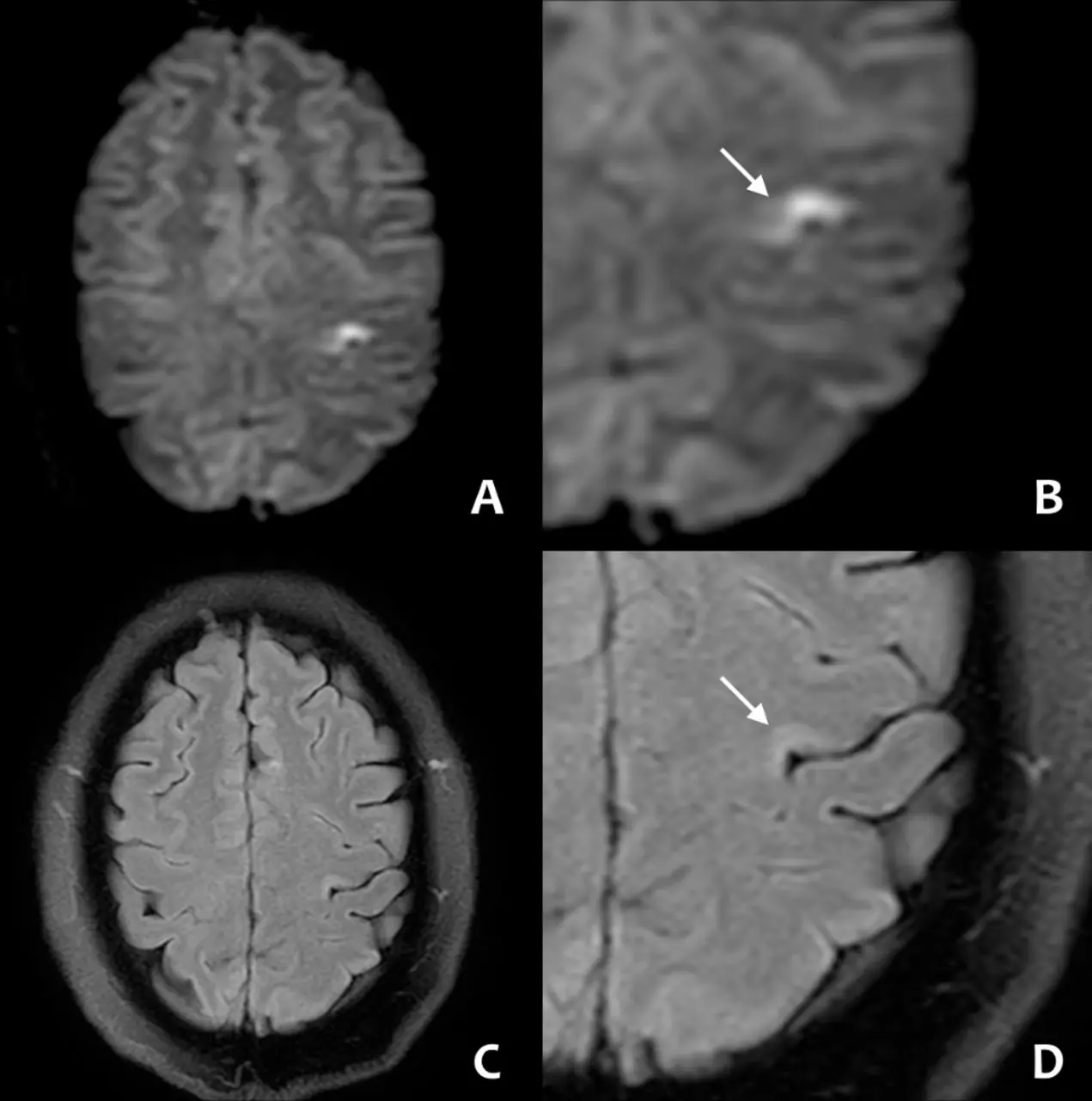 วัย 19 ปีเป็นโรคหลอดเลือดสมอง หลังมีอาการปวดหัว แพทย์เตือน 5 สัญญาณอันตรายที่ต้องจำ