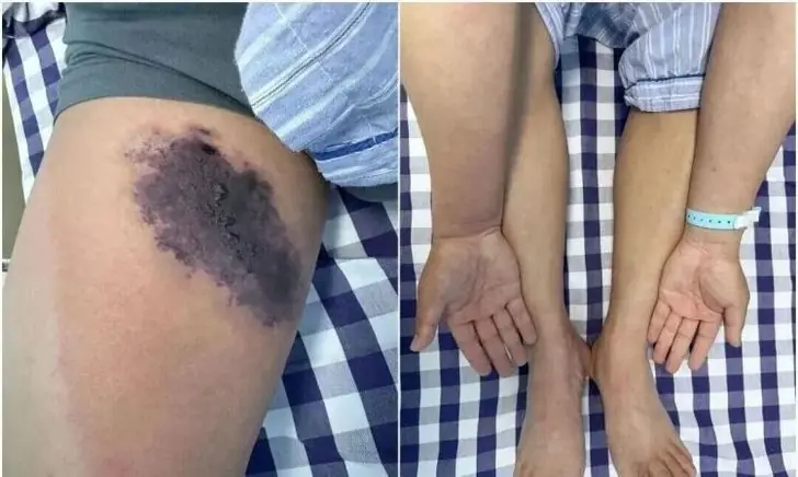 เตือนภัยใกล้ตัว! แค่ใส่กางเกงเก่า หนุ่มช็อก "เนื้อเน่า" เกือบดับเพราะพิษแพร่ทั่วร่าง