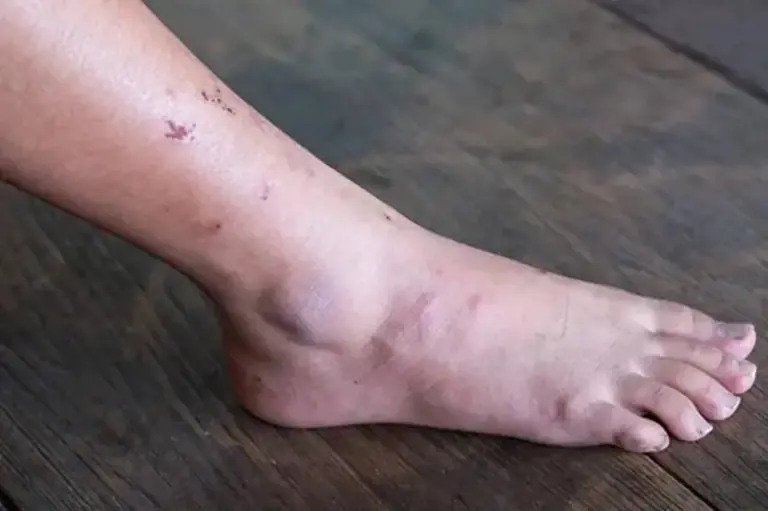 เมื่อม.ะ.เ.ร็.งเริ่มก่อตัวในระ.ยะแ.รก ร่างกายมักมีสัญญาณ “ผิ.ดป.กติ” 3 อย่าง แต่หลายคนมักมองข้