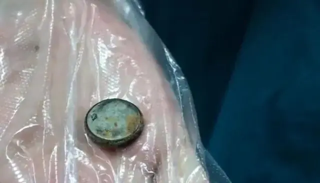 ชื่นชม! ลูก 3 ขวบ กลืนถ่านกระดุม แม่รีบให้กิน "สิ่งนี้" ตามไป 1 ช้อน ก่อนอุ้มส่งหมอ