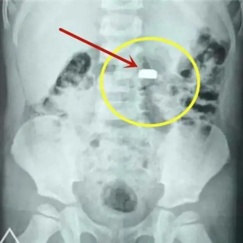 ช็อก! เด็กอายุ 3 ขวบกลืนถ่านกระดุมเข้าไป แม่รีบให้วิธีแก้เบื้องต้นนี้ ก่อนพาส่งโรงพยาบาลท