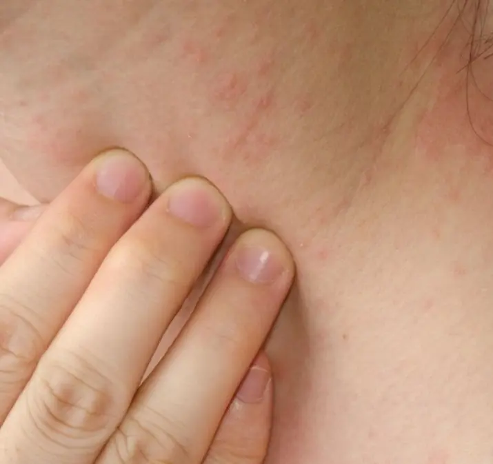 แพทย์เตือน! คันผิดปกติ 4 จุดบนร่างกาย อาจเป็นสัญญาณเตือน “ม.ะ.เ.ร็.งตั.บ” ที่หลายคนมองข้าม