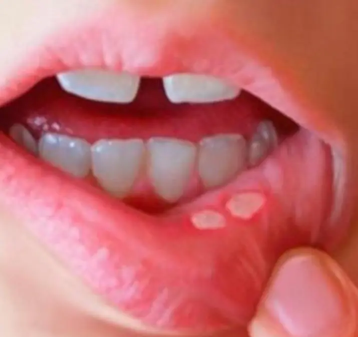 แพทย์เตือน 4 อาการผิดปกติในช่องปาก อาจบ่งชี้มะเร็งระยะแรก