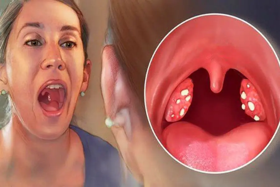 จู่ ๆ ก็รู้สึกเหมือนมีสิ่งแปลกปลอมติดอยู่ในลำคอ กลืนเท่าไรก็ไม่หาย…ก่อนจะมีเม็ดเล็ก ๆ หล