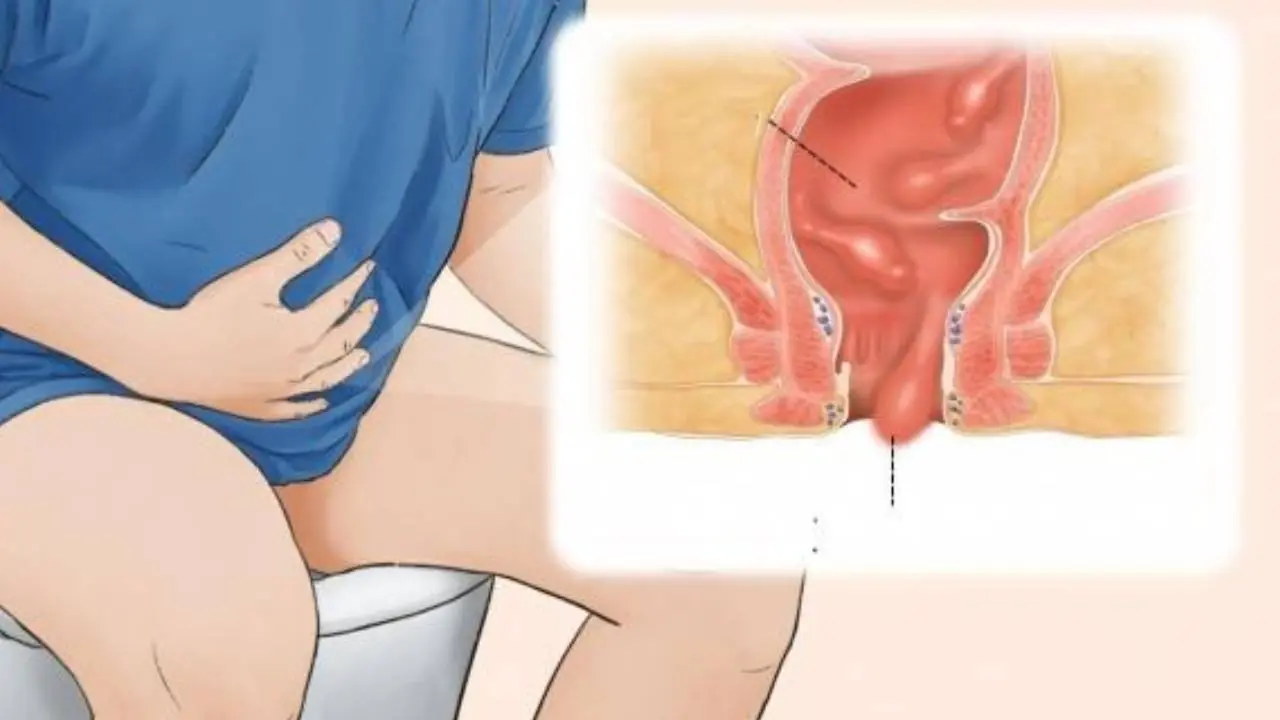 หากคุณมีติ่งเนื้อในลำไส้ จะมี 4 สัญญาณเตือนขณะเข้าห้องน้ำ อย่ารอให้ถึงระยะสุดท้ายแล้วค่อ