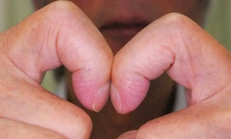 วางปลายนิ้วชี้ทั้งสองข้างชิดกัน ก็สามารถคาดเดาได้ทันทีว่าตัวเองมีความเสี่ยงเป็นมะเร็ง