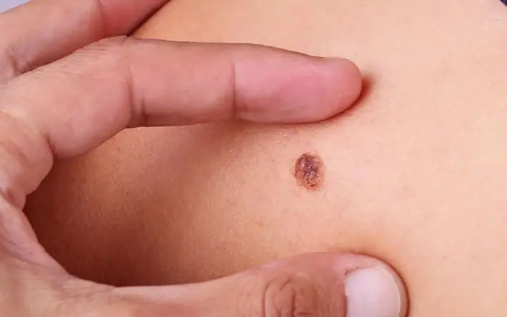 5 สัญญาณเตือนภัยเงียบจากร่างกายที่อาจบ่งบอกถึงโรคร้าย