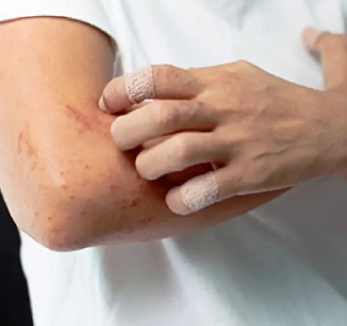 อาการคัน 2 บริเวณบนร่างกายอาจเป็นสัญญาณของมะ.เร็.งตั.บ หลายคนกลับเข้าใจผิดว่าเป็นภูมิแพ้