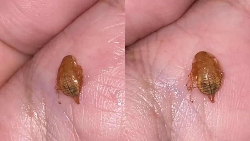 สยอง! ไอแรงจนหลุดออกมา วัตถุประหลาดติดคอ 3 วัน ดูชัดๆ คืออะไร