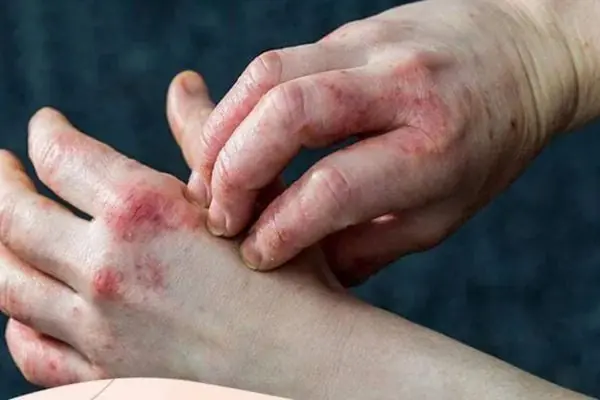 ไข่ไก่มีคุณค่าทางโภชนาการสูงมาก แต่ห้ามกินแบบนี้เด็ดขาด