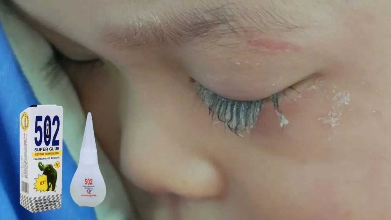 เด็กชาย 3 ขวบถูกกาว 502 กร.ะเ.ด็นเข้าตา การตัดสินใจของแม่ใน “30 วินาทีทอง” ช่วยลูกพ้นจากการสูญเ