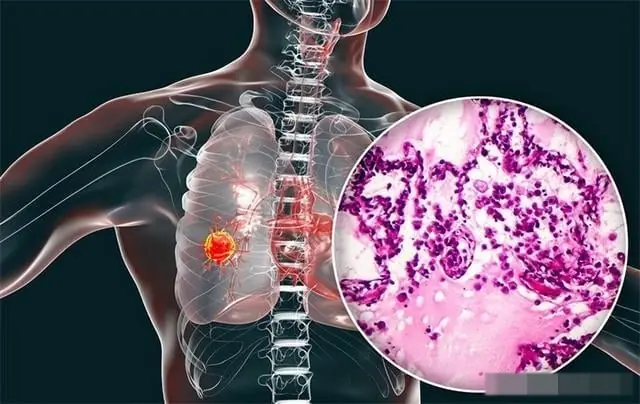 คำเตือน: ม.ะเ.ร็.งปอดเพิ่มขึ้น แพทย์แนะให้หลีกเลี่ยง 4 ประเภทอาหารที่เก็บไว้นานในตู้เย็น