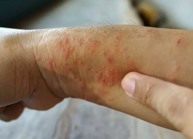 โรคมากับดินน้ำ! "ไข้ดิน" เสียชีวิตแล้ว 23 ราย ป่วย 732 ราย เตือนเกษตรกรกลุ่มเสี่ยง รีบเช็กอาการ