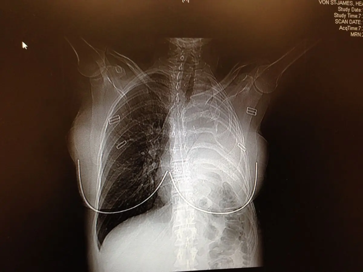 สาววัย 36 ช็อก! หมอบอกเหลือเวลาชีวิตแค่ 15 เดือน เหตุวัยเด็กชอบใส่ "เสื้อคลุมพ่อ"