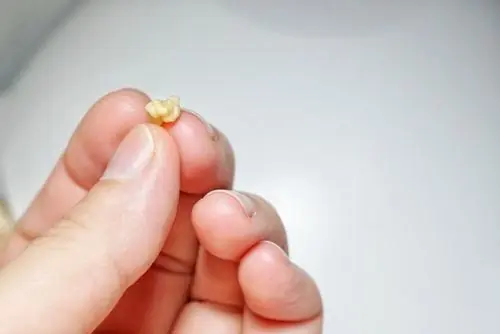 หนุ่มวัย 32 ถูกแฟนบอกเลิกเพราะปากมีกลิ่น ไปหาหมอแล้วช็อกเมื่อรู้สาเหตุ