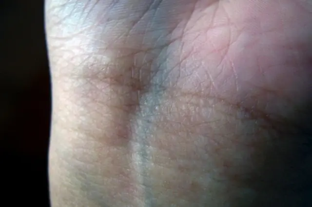 ถ้าคุณเห็นใครที่มีเส้นเลือดสีน้ำเงินจำนวนมากบนแขน ให้บอกเขาเกี่ยวกับเรื่องนี้ด้วย