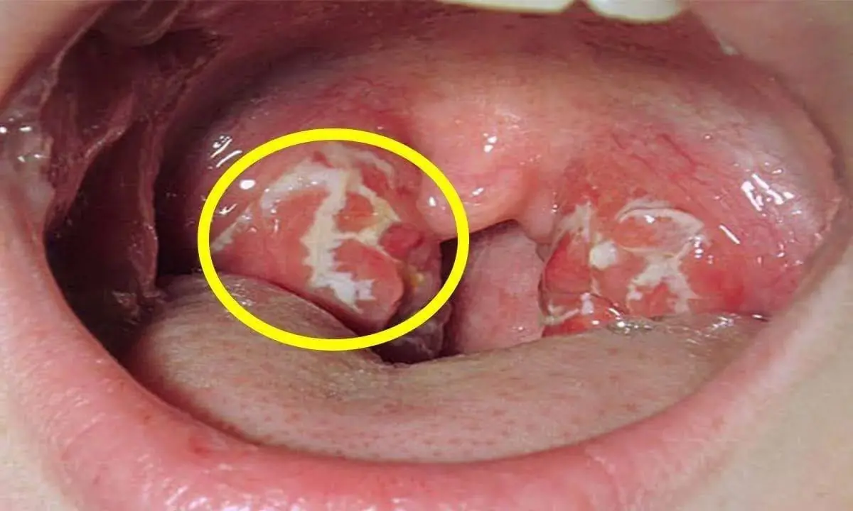 คำเตือน: หากร่างกายมีสัญญาณนี้ ต้องรีบไปโรงพยาบาลทันที มิฉะนั้นอาจเป็นมะ.เร็.งโพ.รง.หลังจม