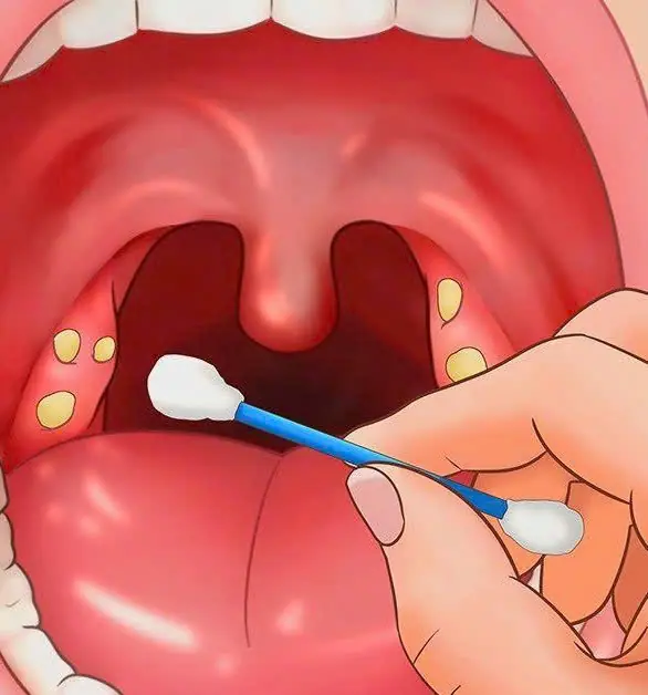 ชายวัย 32 ถูกแฟนบอกเลิกเพราะกลิ่นปาก พอไปหาหมอถึงช็อก! เมื่อเห็นสิ่งที่ถูกดึงออกมา