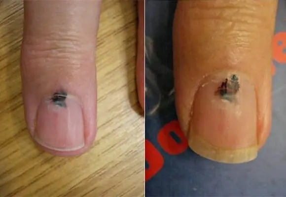 6 ส่วนของร่างกายที่มีสีดำ อาจเป็นสัญญาณเตือนความเสี่ยงมะ.เร็.ง อย่ามองข้าม!