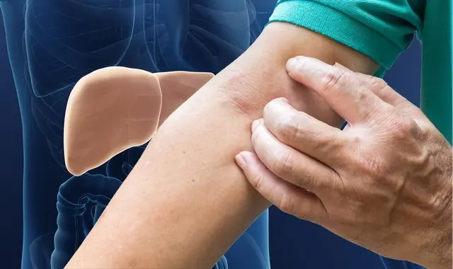 3 สัญญาณบนผิวหนัง ที่เตือนว่าเป็นไขมันพอกตับรุนแรง