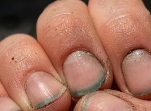 เล็บเปลี่ยนสีบอกเหตุร้าย! สัญญาณเตือนที่ห้ามมองข้าม