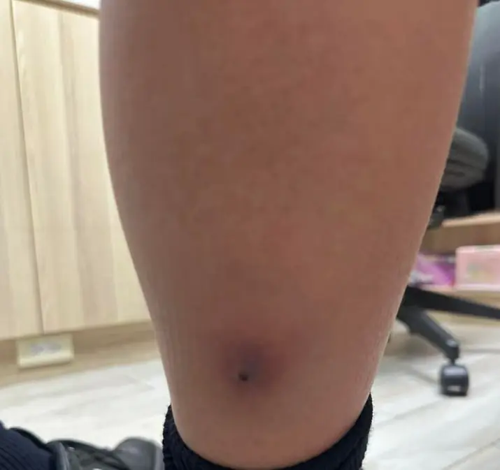 เด็กชายวัย 12 ไข้ขึ้นคิดว่าแค่ไข้หวัดใหญ่ หมอเปิดขาดูช็อก รีบส่ง ICU ด่วน