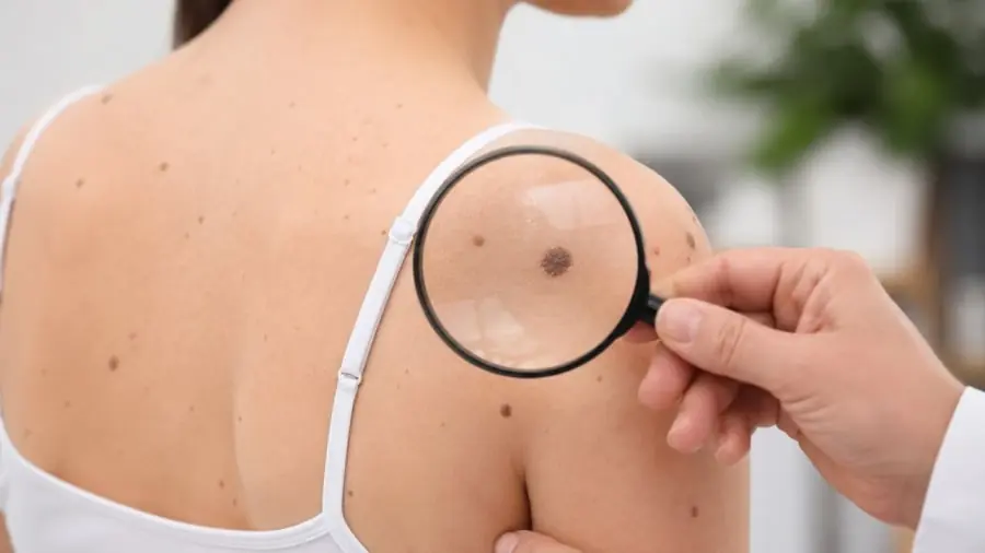 5 สัญญาณผิดปกติบนผิวหนัง อาจเป็นสัญญาณเตือนม.ะ.เ.ร็.ง อย่ามองข้ามเด็ดขาด