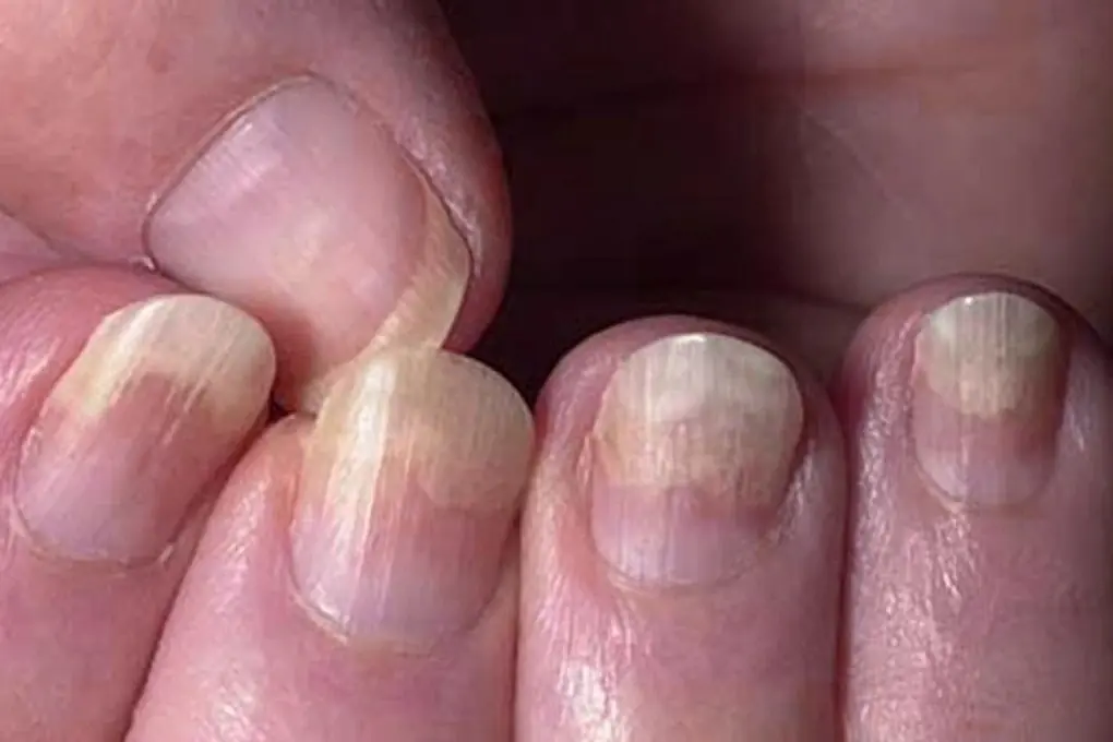 สัญญาณเตือนจากเล็บ: เมื่อความผิดปกติไม่ใช่แค่เรื่องความสวยงาม