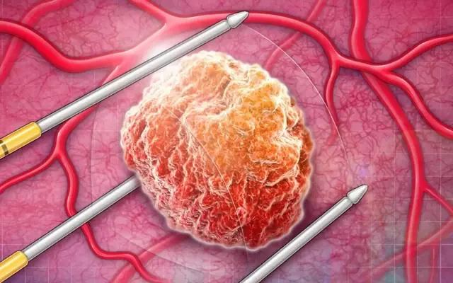 พ่อกับลูกชายเป็นมะเร็งชนิดเดียวกัน บอก 3 สิ่งที่ผู้ชายควรทำเพื่อสังเกตอาการตั้งแต่เนิ่น 