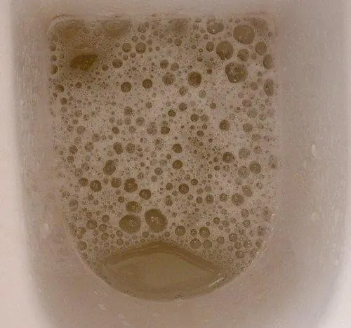 มะเร็งระยะแรกมักไม่เจ็บ หากพบ 8 อาการตอนเช้า รีบพบแพทย์