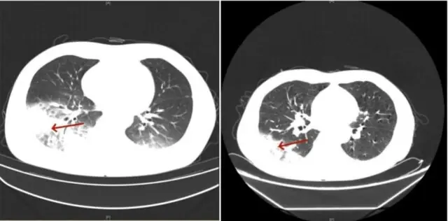 ผู้หญิงคนหนึ่งมีปอดขาวโพลนไปมุมหนึ่ง เพราะของที่แทบทุกบ้านใช้กัน