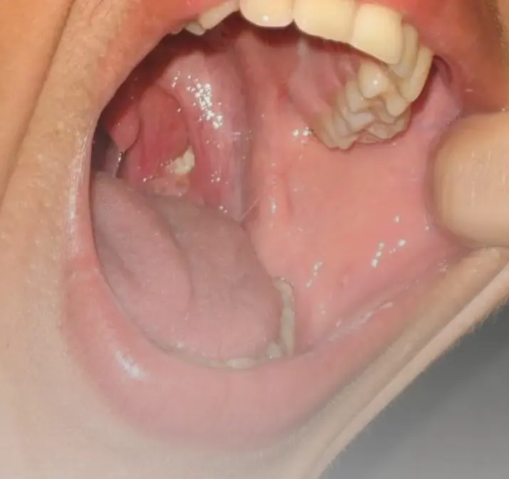 จู่ ๆ รู้สึกเหมือนมีอะไรติดคอ กลืนไม่ลง…แล้วมีเม็ดหลุดออกมา นี่คืออะไรกันแน่?