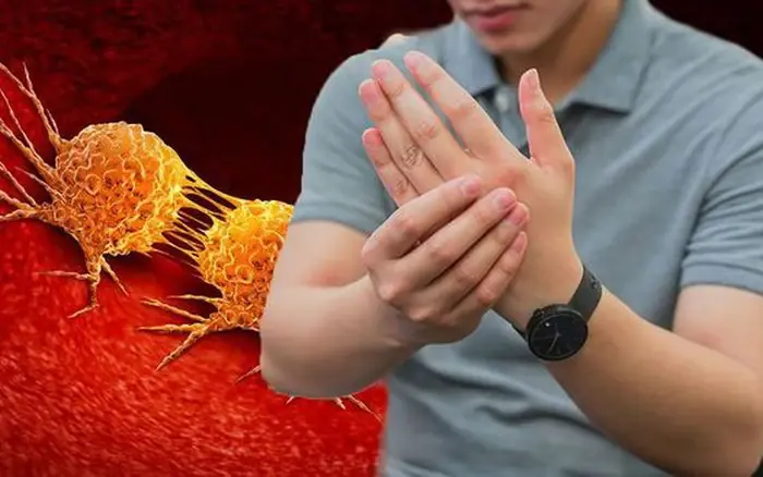 ยื่นมือออกมาแล้วถ้าเห็น 4 สัญญาณนี้ ต้องระวังโรคมะเร็งและโรคหัวใจ