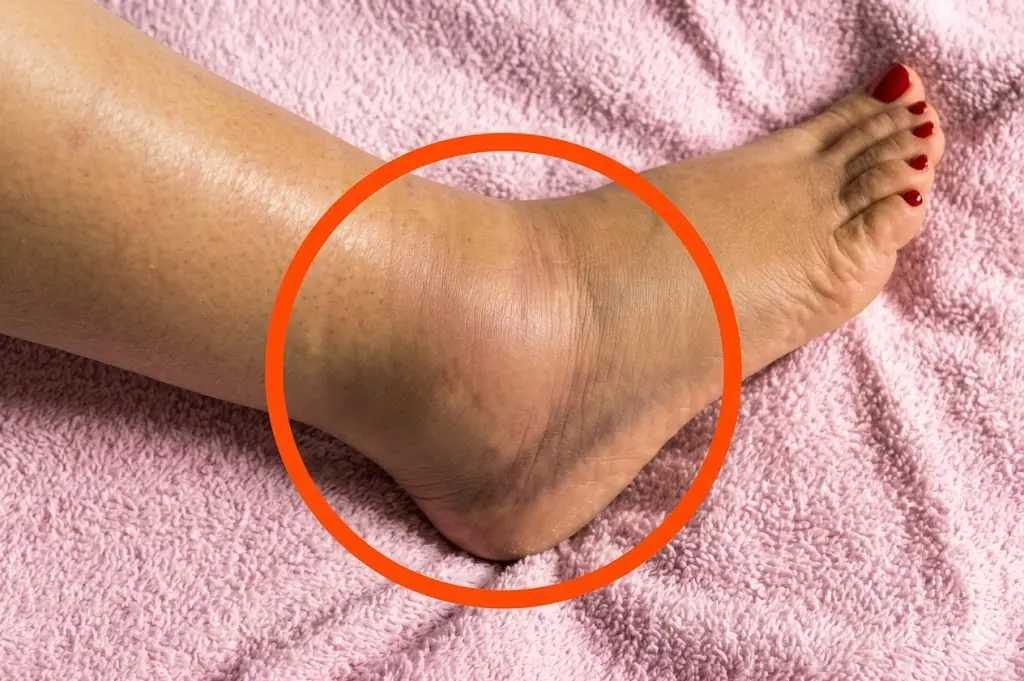หากคุณสังเกตว่า “ขาบวม” นี่อาจเป็นสัญญาณของ…