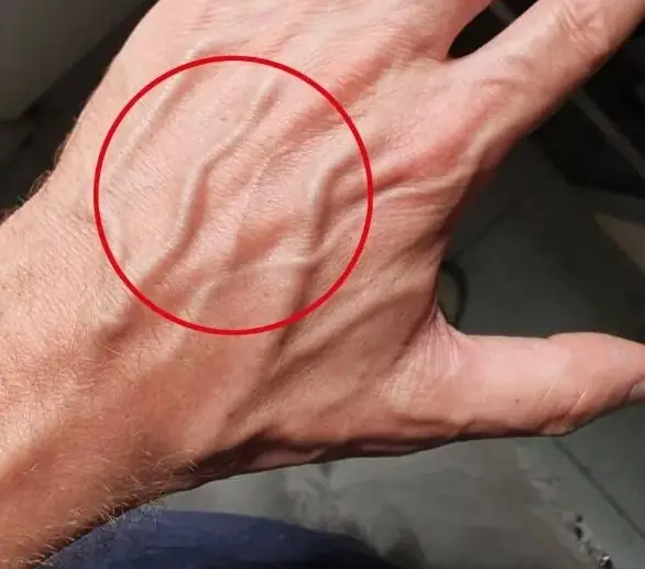 เห็นเส้นเลือดชัดบนหลังมือ หมายความว่าอะไร?