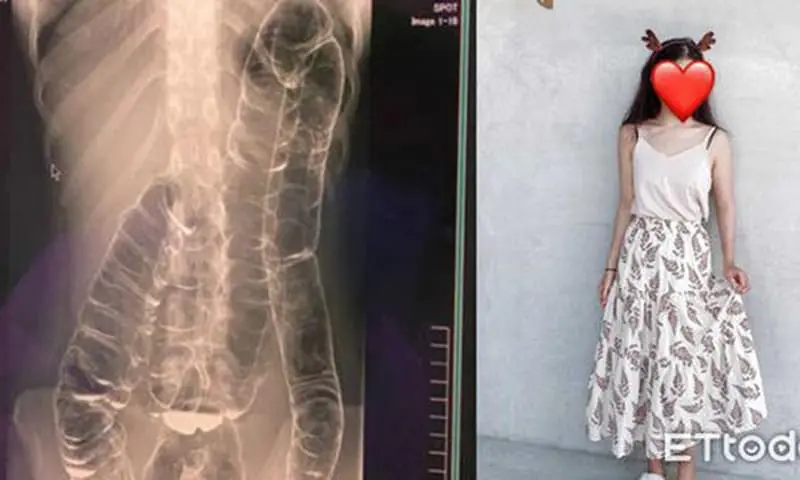 ช็.อก! ลำ.ไส้สาวหนุ่มอุดตัน ไม่ถ่ายนาน 17 วัน พบโร.ครุน.แรงจากภาพเอ็กซเรย์