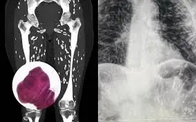 พยาธิไชทั่วร่างกาย เหตุจากวิธีปรุงเนื้อหมูแบบหนึ่งที่คนไทยนิยมทำเป็นประจำ