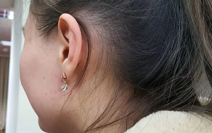 พบรอยดำสกปรกที่คอแต่ล้างไม่ออก เด็กหญิงวัย 15 ปีถึงกับช็อกเมื่อแพทย์เผย "นี่คือโรคชนิดหนึ