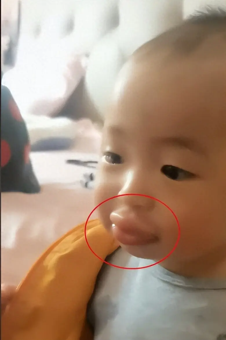 เด็กถูกต่อยจนปากบวมหนัก แต่การตัดสินใจของแม่ทำหมอชมไม่หยุด