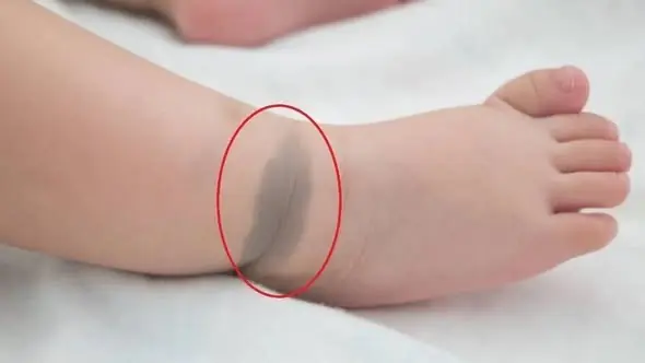 เด็กที่มีปานอยู่ใน 6 ตำแหน่งนี้ คนโบราณเชื่อว่าเป็น “ปานแห่งโชค” อนาคตมีวาสนาและความสำเร็