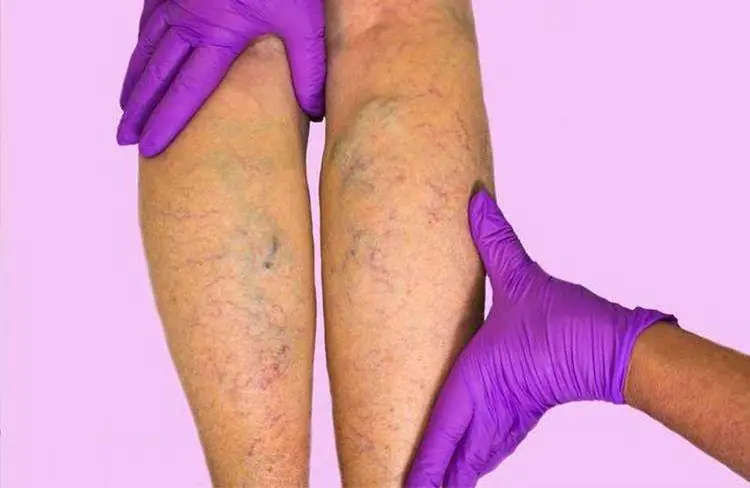 ขาบวมเกิดจากอะไร? สาเหตุที่พบบ่อยและสัญญาณอันตรายที่ไม่ควรมองข้าม