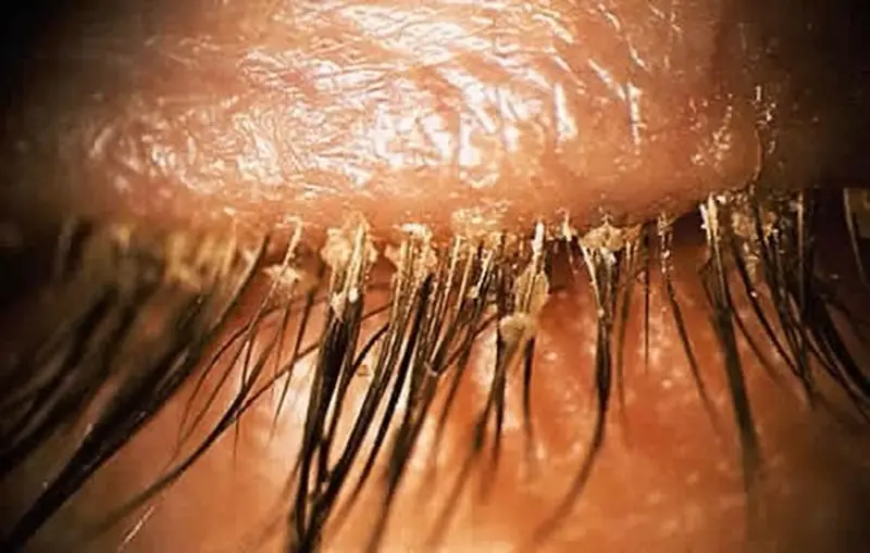 เคล็ดลับการดูแลสุขภาพรอบดวงตา ป้องกันสิ่งสะสมที่โคนขนตาอย่างถูกวิธี