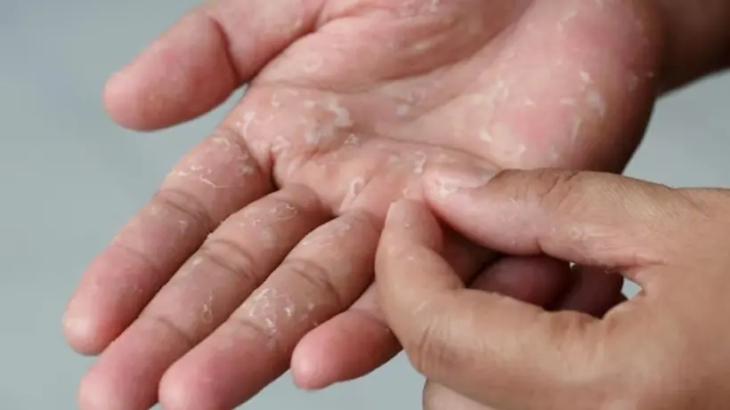 5 สัญญาณเตือนที่มือ: รีบตรวจไตด่วน ก่อนจะสายเกินไป!