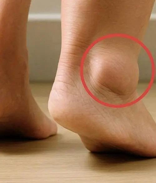 หากสังเกตว่าขาบวม นี่อาจเป็นสัญญาณของโรคบางอย่างที่กำลังคืบคลานโดยไม่รู้ตัว