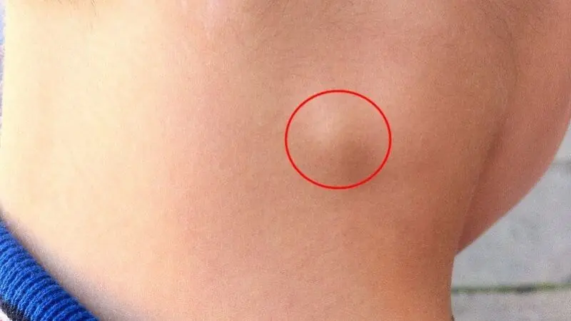 ม.ะ.เ.ร็.งไม่เคยมาเงียบ ๆ! ร่างกายส่ง 5 สัญญาณเตือนสำคัญ หากพบอย่านิ่งนอนใจ รีบตรวจทันที