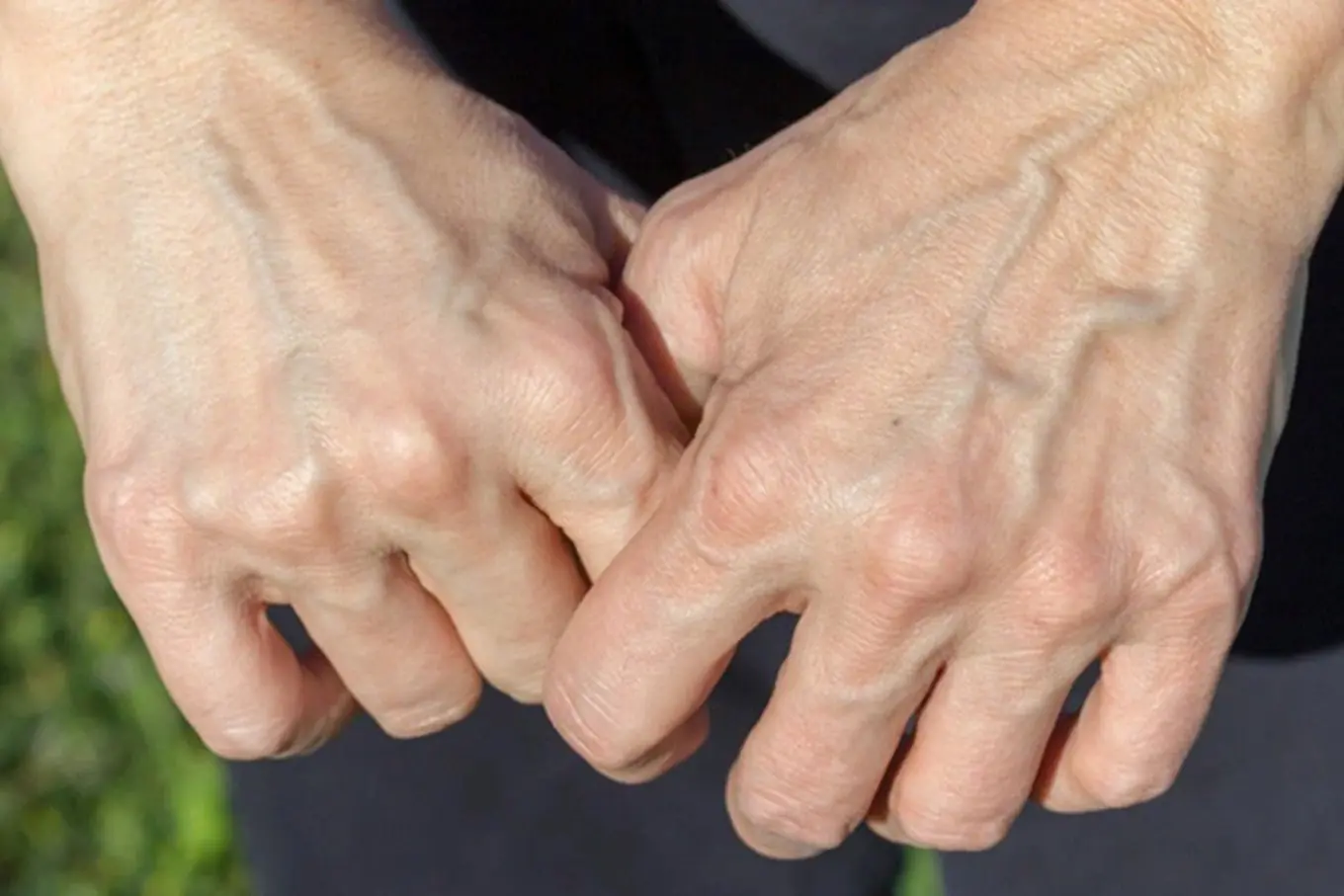 5 สัญญาณบนมือที่บ่งบอกถึงโรคร้ายแรง