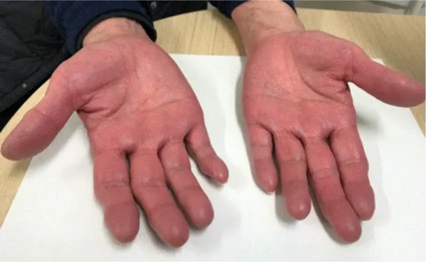 หากพบ 5 สัญญาณเตือนนี้บนมือ ควรรีบไปตรวจไตทันที!