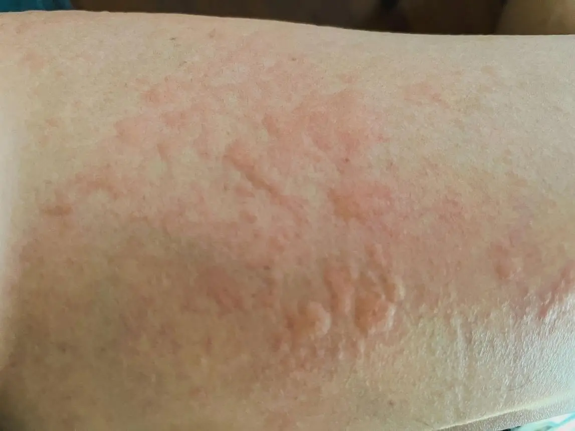 ระวังให้ดี! หากร่างกายของคุณคันและมีตุ่มแบบนี้ขึ้นบนผิวหนัง