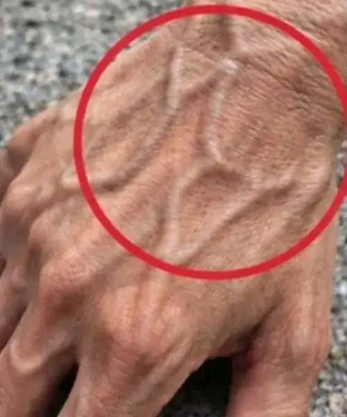 ถ้าคุณเห็นใครเส้นเลือดบนมือปูดชัด รีบบอกเรื่องนี้กับเขา เพราะข้อมูลนี้อาจช่วยชีวิตเขาไ